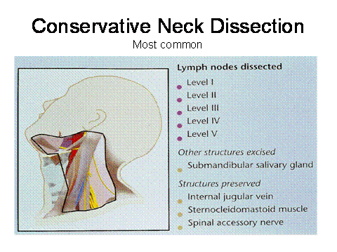 radical neck dissection